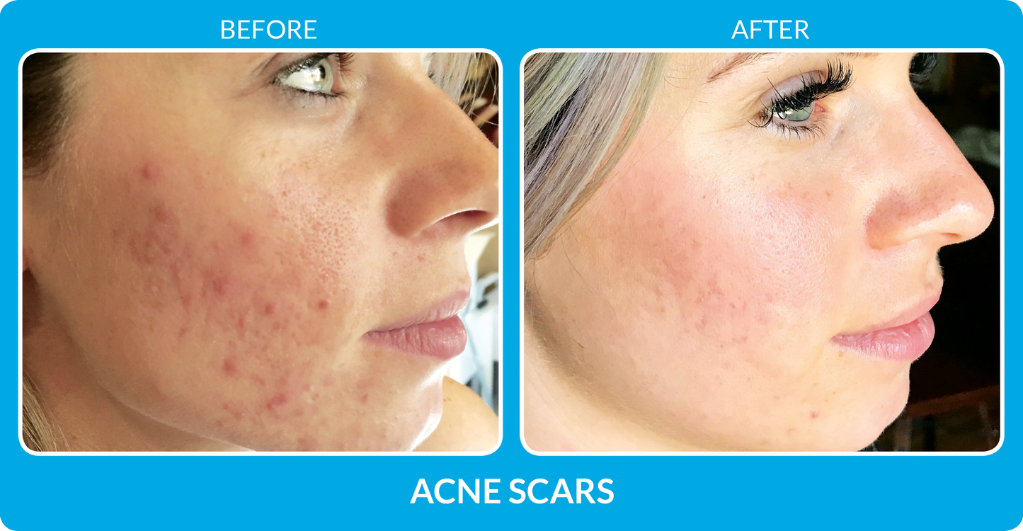 MicroCLEAR Acne Reset