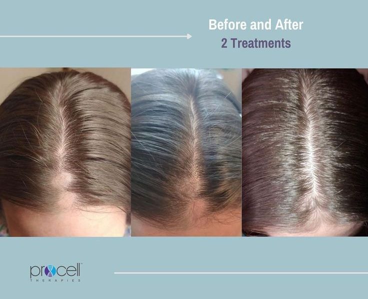 Scalp Therapy 3 Treatment Microchanneling Package