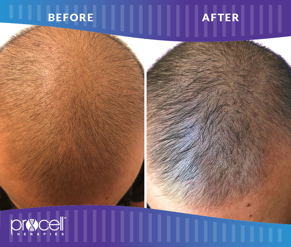 Scalp Therapy 3 Treatment Microchanneling Package
