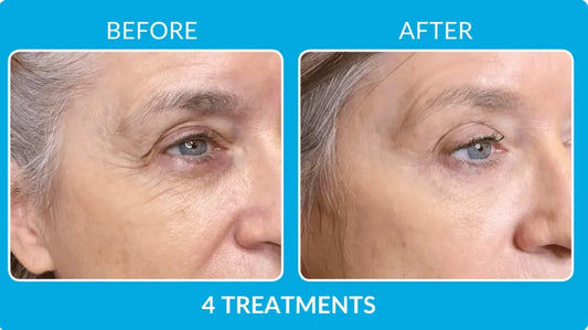 MicroBARRIER Longevity Reset Program (6 Treatments and Skincare)